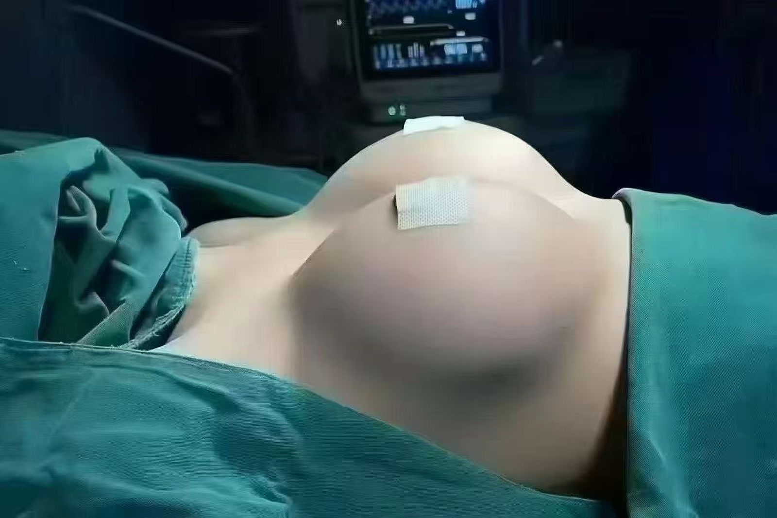 胸部美学案例：术后形态记录
