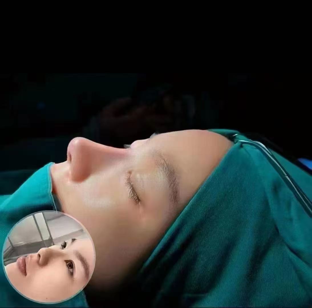 鼻部美学案例：即刻轮廓记录